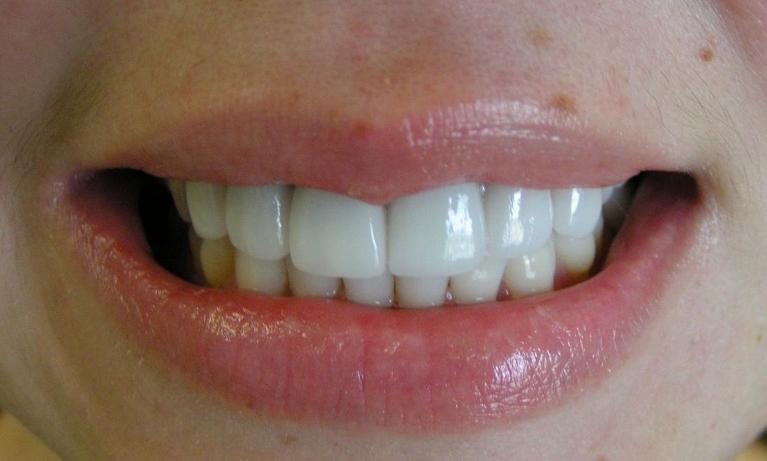 Cosmetic-Dentistry-Veneers-After-Image