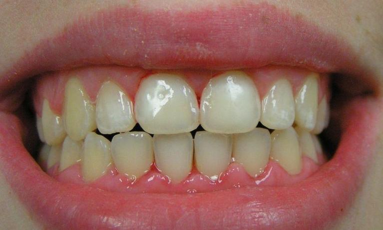Cosmetic-Dentistry-After-Image