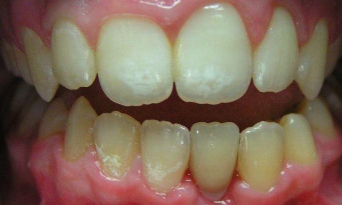 Cosmetic-Implants-After-Image