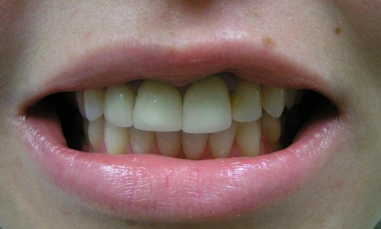 Cosmetic-Dentistry-Veneers-Before-Image
