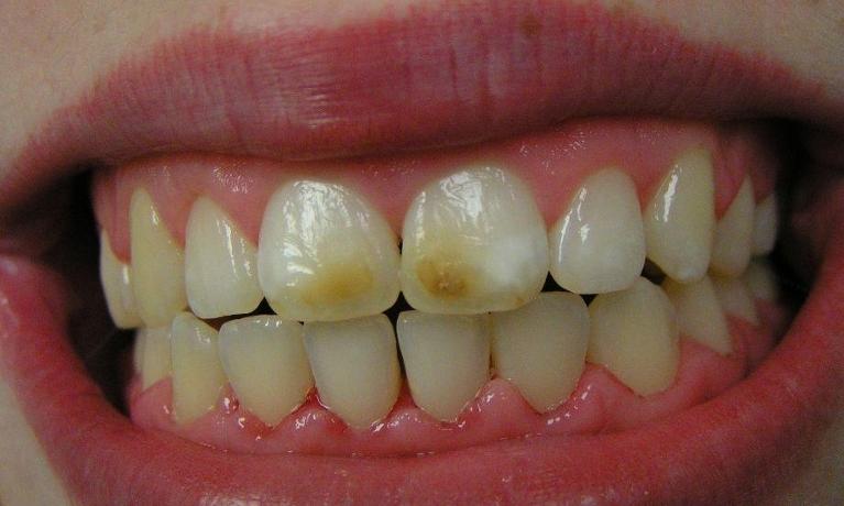 Cosmetic-Dentistry-Before-Image