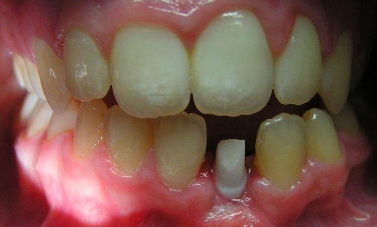 Cosmetic-Implants-Before-Image